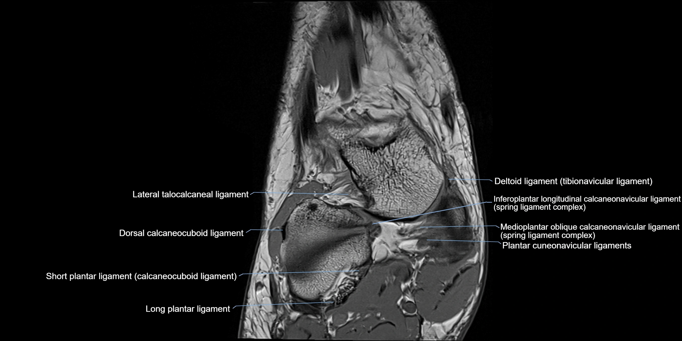 MRI Ankle coronal ligaments cross sectional anatomy 3T  radiology  image-img-00001-00004.webp